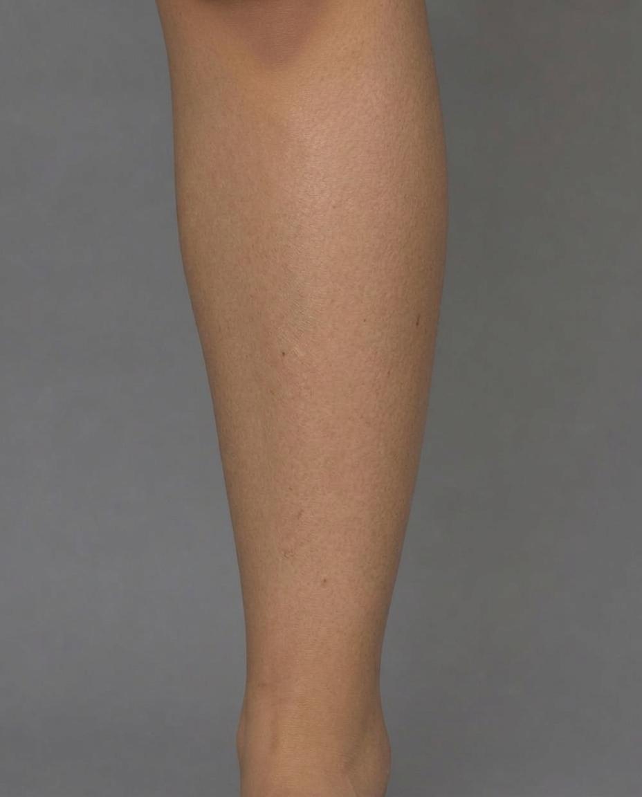 Laser Hair Removal result at New Me Clinic