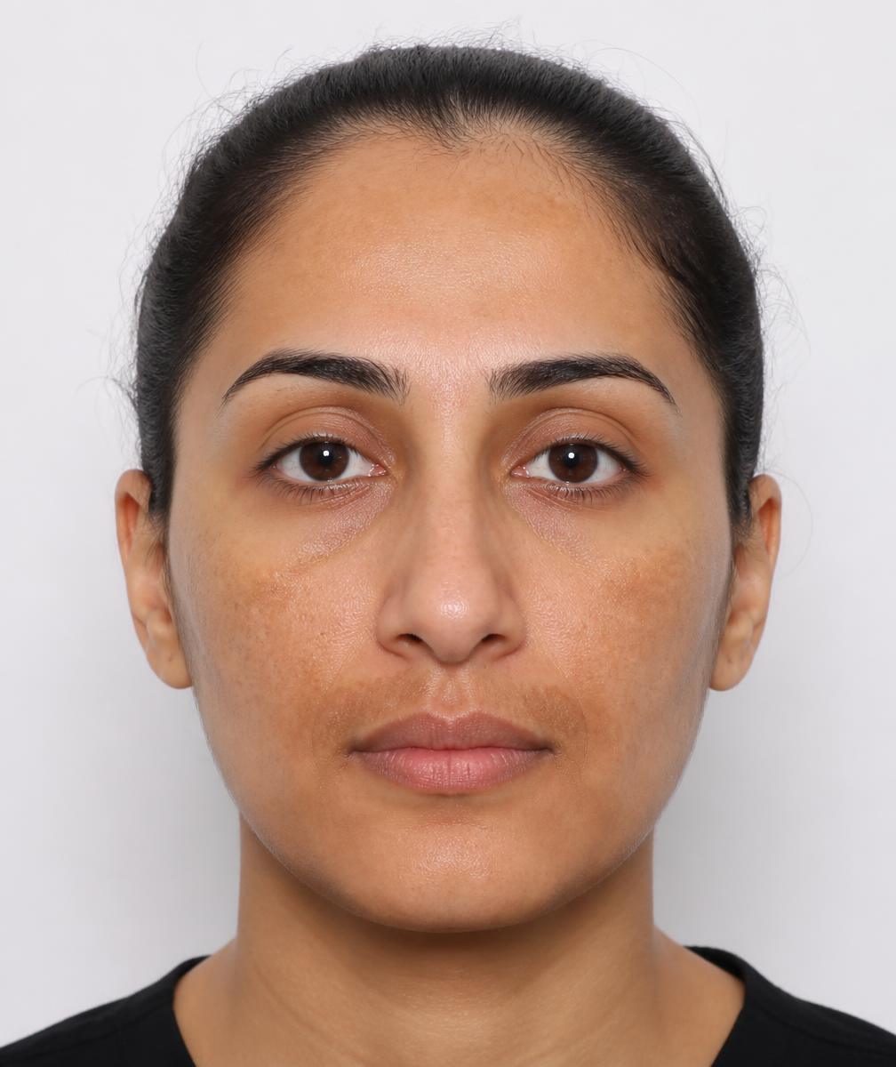 Before treatment — Melasma & pigmentation