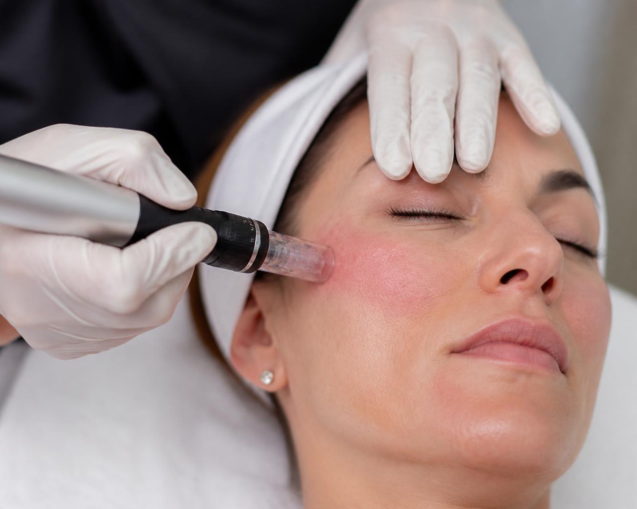 Microneedling treatment at New Me Clinic