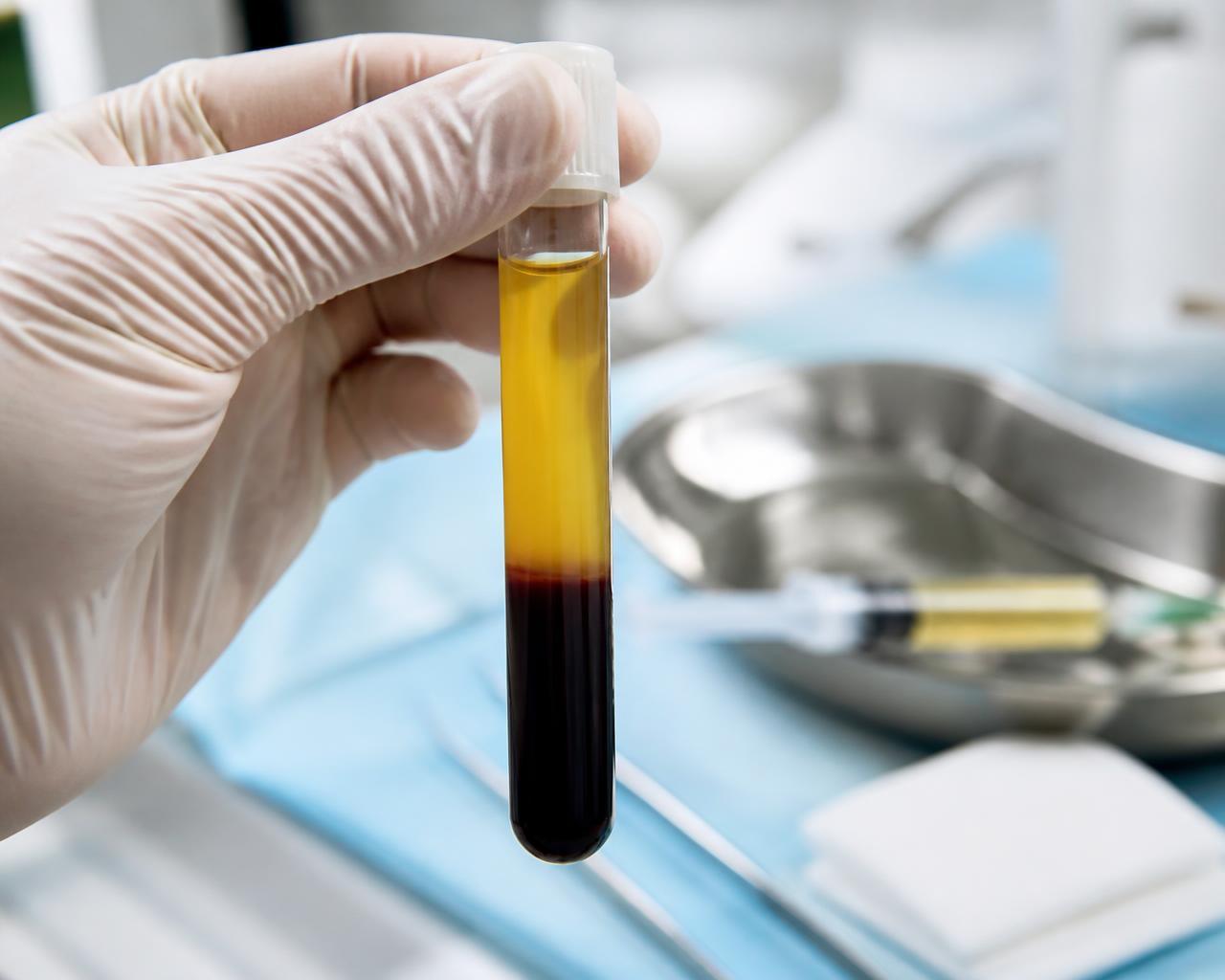 PRP treatment at New Me Clinic